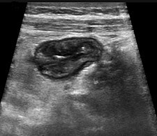 Cross-sectional image of the terminal ileum