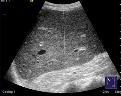 An ARFI examination can be performed on patients with ascites and those in whom liver stiffness measurement by transient elastography could not be obtained. Image courtesy of Dr. Ioan Sporea.