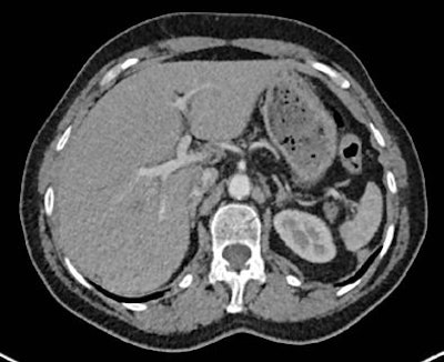 Image reconstruction with raw data-based SAFIRE shows markedly reduced image noise and sharper depiction of vessel contours.