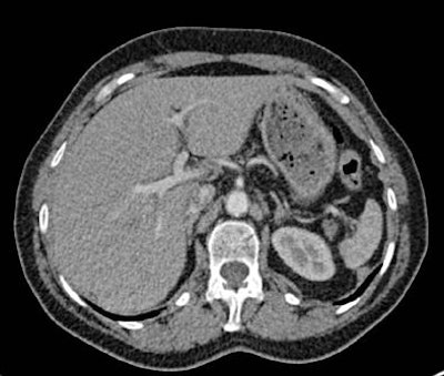 Images of the upper abdomen reconstructed using filtered backprojection (FBP) and the sinogram affirmed iterative reconstruction (SAFIRE) algorithm. Above, transverse image reconstruction with standard FBP at the level of the upper abdomen shows a high level of image noise. All images courtesy of Dr. Alkadhi Hatem.