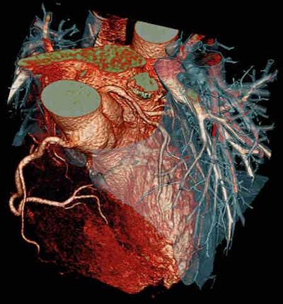 Cardiac CT images look stunning, but the technique is not perfect. This CT scan used the Flash Spiral Cardio facility of the Somatom Definition system. A 0.9 mSv dose was needed to show the fine details. Image courtesy of Siemens Healthcare.