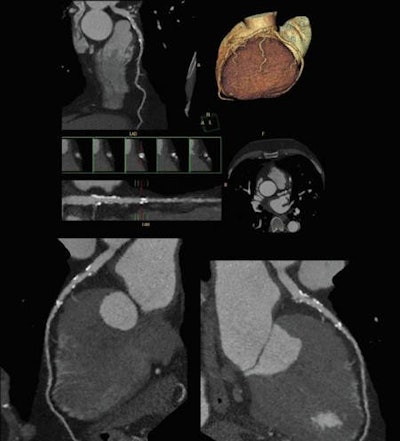 Cardiac CT angiography performed at lower x-ray dose can help to characterize cardiovascular disease. Image courtesy of Philips Healthcare.