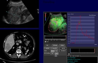 Contrast-enhanced ultrasound can play an important role in monitoring tumor response. This patient with hepatic metastasis of renal cell carcinoma was treated with temsirolimus (Torisel) and bevacizumab (Avastin). Image courtesy of Dr. Nathalie Lassau, head of ultrasonography unit at Institut Gustave Roussy in Villejuif, France.