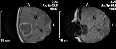 Exemplary T1-weighted contrast-enhanced images obtained at 0.15 tesla before (left) and after tumor resection (right), showing no residual tumor.