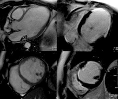 MRI of postischemic dilated cardiomiopathy