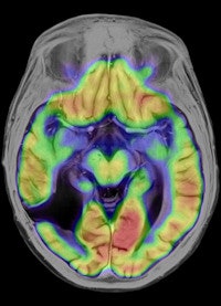 Advances have occurred in functional MRI of the brain, but change is needed for it to achieve its clinical potential. Image courtesy of Siemens Healthcare.