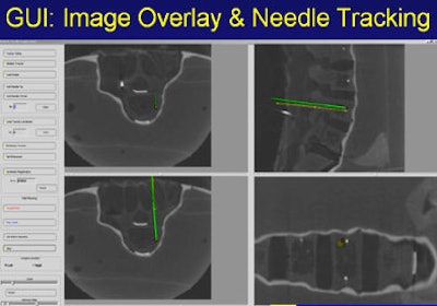 Graphic user interface of vertebroplasty