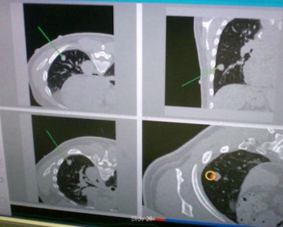Automated lung biopsy is performed in the CT suite. A clinical study of four patients found perfect targeting of three patients' tumors, and a near miss on the fourth patient that was corrected.