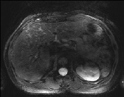 T2-weighted TSE image is strongly impaired at 7-tesla, lacking any relevant diagnostic value.