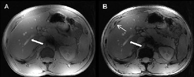 T1-weighted 2D in (A) and opposed (B) phase MRI provides conspicuity of liver vasculature (arrows) and typical sharply defined black rims around organs with a fat/water interface in the opposed phase image (slim arrow). All images courtesy of Dr. Lale Umutlu.