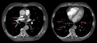 CT images of pulmonary embolism (above; pulmonary emboli are indicated by arrows) and knee MR images (below). Images were exported from an iPad 2.