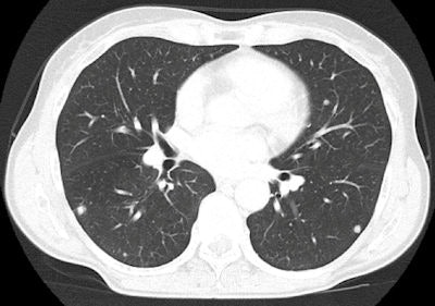 Chest CT image of lung nodules. Image was exported from an iPad 2. All images courtesy of Dr. Lorenzo Faggioni.