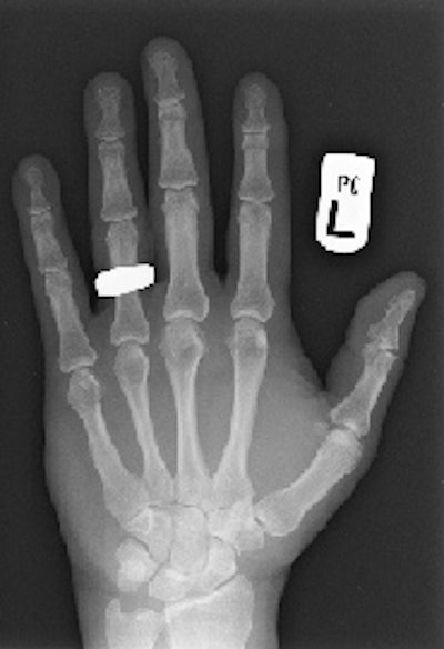 This digital radiograph of Dr. Adrian Thomas' own hand was taken on 8 November 2005, 110 years after the discovery of x-rays. All images courtesy of Dr. Adrian Thomas.