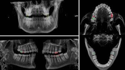 A volume rendering preset suggestion to apply for dental CT data based on the investigated teeth. White for physiological dental structures such as dentine and enamel. Low opaque composite fillings are shown in green whereas high opaque composite fillings are shown in red.