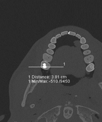Cross section of investigated teeth and Hounsfield unit profile along a measurement indicated as a white line in the molar. All images courtesy of Dr. Christian Jackowski.