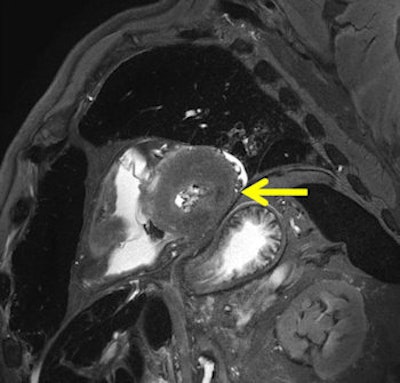 Peracute myocardial infarction in postmortem MRI (death occurred after minutes to one hour). A T2-weighted short axis image presents with a local hypointensity within the lateral wall without hyperintense edematous margin. Autopsy aspect of the specimen showed no visible alteration within the affected myocardium (not shown). Histology also failed in demonstrating ischemic alterations (not shown). Dissection of the coronary artery system revealed a fresh soft plaque rupture with intimal hemorrhage within the circumflex coronary artery (not shown).