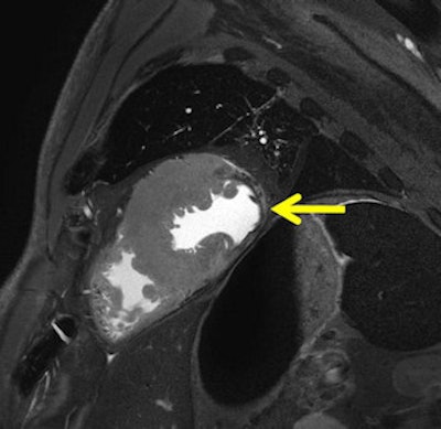 Chronic myocardial infarction in postmortem MRI (death occurred months to years after infarction). A T2-weighted short axis image depicts a severe shrinking of the lateral wall with broad decrease of signal (arrow). Autopsy demonstrated definite collagenous transformation of the infarcted inferior myocardium with scar-caused shrinking (not shown). Histology (H&E) showed cell-free collagen formation as the cause for the significant decrease of signal in MRI.
