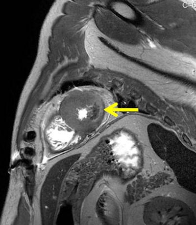 Acute myocardial infarction in postmortem MRI (death occurred after two to three days). A T2-weighted short axis image demonstrates a hypointensity with surrounding edema within the lateral wall. Autopsy revealed a yellowish alteration at the same location (not shown). Histology demonstrated early granulocyteous infiltration (not shown).