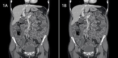 Image data reconstruction of an abdominal scan with standard filtered back projection at full dose (1A), and scanned at 60% lower dose while reconstructed with iterative reconstruction in image space (1B). Despite the fact that 1B was acquired at significantly lower dose, it shows the same low noise compared with the standard FBP at full dose. Image courtesy of Siemens Healthcare.