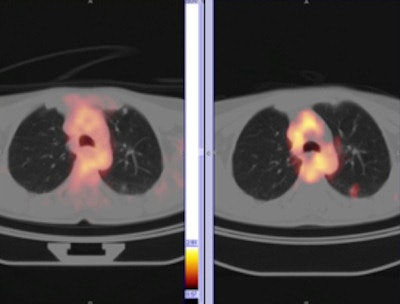 Metabolic characterization of a lung nodule in the left lower lobe. FDG-PET (left panel) shows no uptake, indicating that the glucose metabolism is not elevated in the nodule. Carbon-11-methionine PET reveals increased metabolic activity in the lung lesion. Pathology confirmed the nodule as a bronchoalveolar carcinoma.