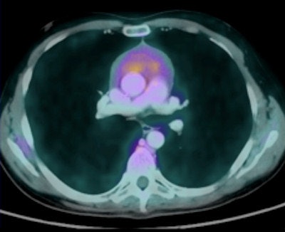 Postchemotherapy imaging of a mediastinal lymphoma. Axial image shows contrast-enhanced chest CT, registered and fused with FDG-PET. Metabolic and structural information can be evaluated in a single image. All images courtesy of Dr. Arturo Chiti, Humanitas Clinical Institute, Milan.