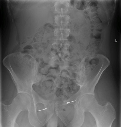 Plain x-ray of a suspected drug smuggler, who later passed two large, regularly oval, 50 x 35-mm hard plastic containers containing illegal substances. The containers are located in the rectum between the arrows. It can be difficult to distinguish them from stool. Image courtesy of Dr. Markus Sormaala.