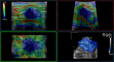 Invasive ductal carcinoma of the breast viewed using real-time 4D tissue elastography technique. Image courtesy of Dr. Ako Itoh of the department of surgery at Hitachi General Hospital in Ibaraki, Japan.