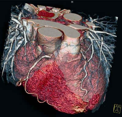 This triple-rule-out cardiac image was captured on a Somatom Definition dual-source CT scanner without the use of beta-blockers at a heart rate of 90 bpm. Image courtesy of Siemens Healthcare.