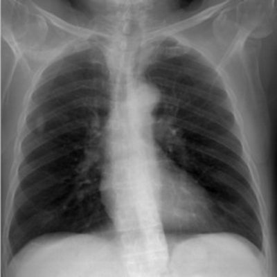 DRR of a chest x-ray reconstructed with an antiscatter grid