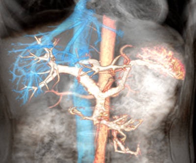 Overlaid images of aorta (red) superior vena cava with hepatic veins (blue) and portal venous system (white) using various time-SLIP techniques.