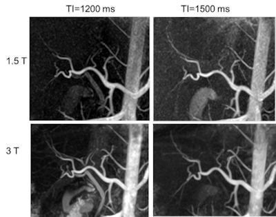 Hepatic artery using time-spatial labeling inversion pulse (time-SLIP) at different TI times at both 1.5- and 3-tesla. Note that long T1 at 3 tesla gives better background suppression even at TI=1500 ms. All images courtesy of Mitsue Miyazaki, PhD, and Dr. Hiroyoshi Isoda.
