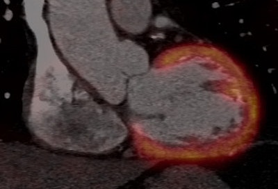 Hybrid techniques are making steady progress in cardiac imaging. In these cardiac PET/CT images, FDG was used as the radiotracer, along with coronary CTA. Above: Multiplanar reconstruction of fused image. Below: 3D reconstruction. All images courtesy of Dr. Gerald Antoch, department of diagnostic and interventional radiology, University Hospital Duesseldorf, Germany.