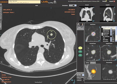 CAD of pulmonary nodules with the LMS platform (pulmonology).