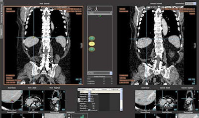 Follow-up of a hepatic lesion with the LMS platform (abdominal radiology) now in routine practice at La Fe Hospital.