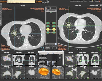 Follow-up of a pulmonary mass with the LMS platform (oncology imaging). Besides oncology imaging specialists, chest and abdominal radiologists will in the future use the software for pretreatment measurements after first detection of tumors. All images courtesy of Median Technologies.
