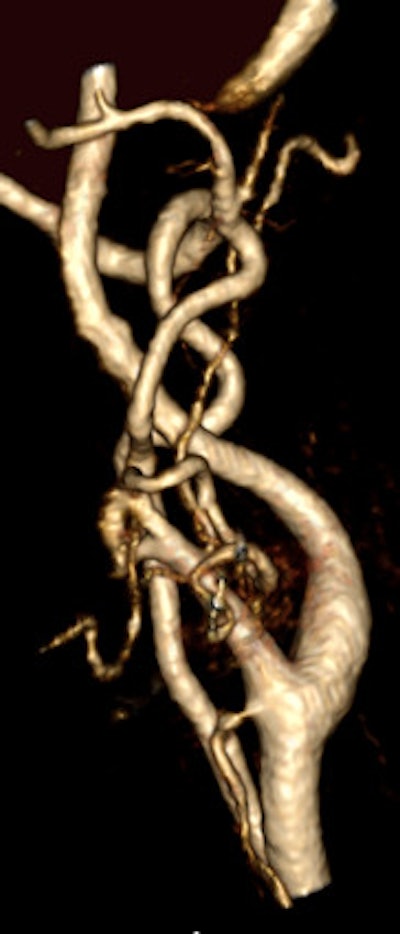 A 45-year-old woman experienced a transient ischemic attack. Coronal anterior inverted MIP (left) and posterior oblique volume-rendered (right) images from a high spatial resolution CE-MRA. The examination was performed by distributing a multiple array of coils over a large FOV (450 mm) to cover the entire supra-aortic arteries from the aortic arch to the vertex on a 3-tesla MR system. After IV injection of 0.1 mmol/kg (approximately 8 ml), the entire 3D dataset was obtained with isotropic voxel size of 0.8 mm³ during acquisition time. Note segmental irregularity and beaded appearance of the cervical segment of the left internal carotid artery compatible with fibromuscular dysplasia. All images courtesy of Dr. Kambiz Nael.