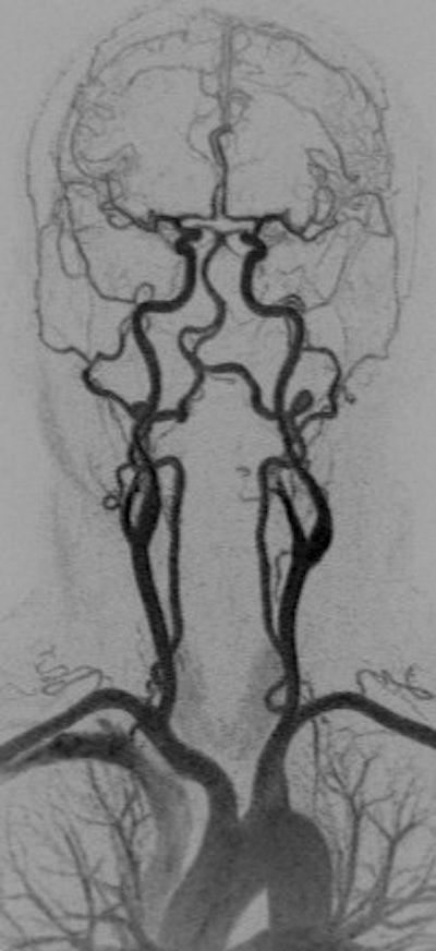 Coronal anterior inverted MIP