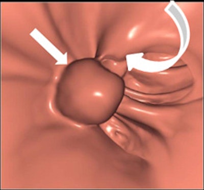 Left: Coronal reformatted view showing a pedunculated polyp of the sigmoid colon. Right: Volume-rendered endoluminal view of the same pedunculated polyp. In both images, the curved arrow indicates the stalk and the straight arrow indicates the head of the polyp. Images courtesy of Dr. Andrea Laghi, University 'La Sapienza,' Latina, Italy.
