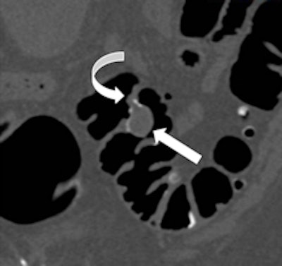 Coronal reformatted view