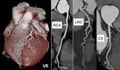 Dual-source cardiac CT in a 55-year-old woman suffering from atypical chest pain. The CT examination was performed using a prospective ECG-triggered cardiac sequence mode (tube voltage 100 kV, tube current time product 200 mAs), resulting in a radiation dose estimate of 1.2 mSv for the examination. Volume-rendered image (VR) on the left and curved reconstructions of the right coronary artery (RCA), left anterior descending artery (LAD), and circumflex artery (CX) demonstrate adequate image quality and absence of relevant coronary stenosis. Image courtesy of Dr. Sebastian Leschka, Zurich University Hospital.