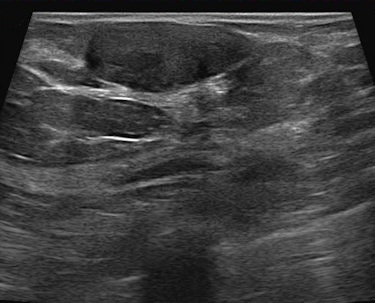 Ultrasound confirms the lesion as a solid homogeneous mass, parallel to the skin. These features suggest a fibroadenoma, but this lesion meets the criteria of the BI-RADS 3 category. Follow-up showed no changes over two years.