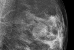 2011 10 06 11 35 39 801 2011 10 07 Procas Breast1