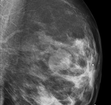 Oblique mediolateral view of the left breast in a 46-year-old woman. A well-delineated lobulated mass can be seen. Ultrasound is needed to classify the lesion as a cyst or a solid mass. All images courtesy of Dr. Luis Pina, University Clinic of Navarra, Spain.