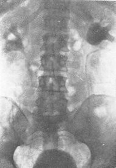 Intravenous urogram (1929) by Dr. Moses Swick (Reproduced from Thomas and Grainger, 1999).