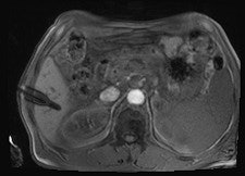 MR-guided biopsy revealed a cavernous hemangioma