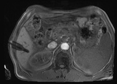 MR-guided biopsy revealed a cavernous hemangioma