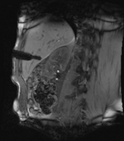 MR-guided biopsy revealed a cavernous hemangioma