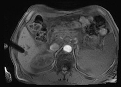 MR-guided biopsy revealed a cavernous hemangioma