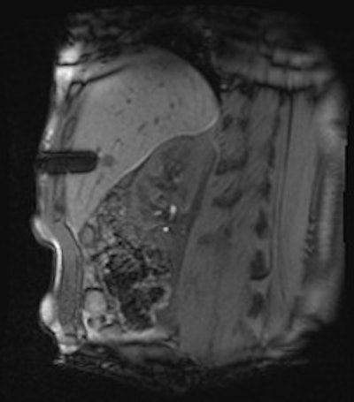 MR-guided biopsy revealed a cavernous hemangioma