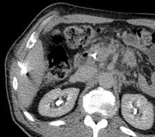 A 50-year-old man with history of pancreatic carcinoma underwent a CT-guided biopsy (above), which was nonconclusive (pathology result: normal liver tissue). Three weeks later, an MR-guided biopsy (below) was performed, and the biopsy revealed a cavernous hemangioma. Images courtesy of Dr. RĂĽdiger Hoffmann.